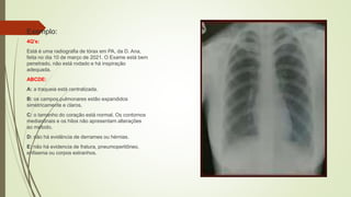 Exemplo:
4Q’s:
Está é uma radiografia de tórax em PA, da D. Ana,
feita no dia 10 de março de 2021. O Exame está bem
penetrado, não está rodado e há inspiração
adequada.
ABCDE:
A: a traqueia está centralizada.
B: os campos pulmonares estão expandidos
simetricamente e claros.
C: o tamanho do coração está normal. Os contornos
mediastinais e os hilos não apresentam alterações
ao método.
D: não há evidência de derrames ou hérnias.
E: não há evidencia de fratura, pneumoperitôneo,
enfisema ou corpos estranhos.
 