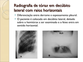 Radiografia de tórax em decúbito lateral com raios horizontais Diferenciação entre derrame e espessamento pleural.  O paciente é colocado em decúbito lateral, deitado sobre o hemitórax a ser examinado e o feixe entra em sentido horizontal. 