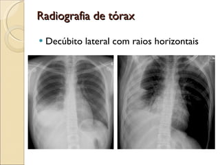 Radiografia de tórax Decúbito lateral com raios horizontais 