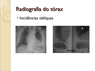 Radiografia do tórax  Incidências oblíquas 