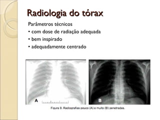 Radiologia do tórax Parâmetros técnicos •  com dose de radiação adequada  •  bem inspirado  •  adequadamente centrado 