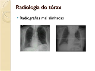 Radiologia do tórax Radiografias mal alinhadas 