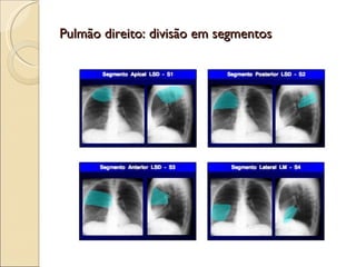 Pulmão direito: divisão em segmentos 