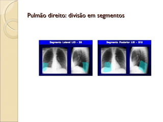 Pulmão direito: divisão em segmentos 