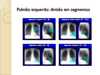 Pulmão esquerdo: divisão em segmentos 