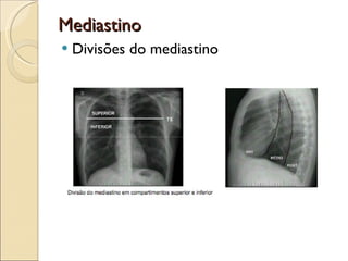 Mediastino Divisões do mediastino 