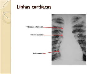 Linhas cardíacas 