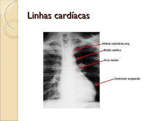 Linhas cardíacas 