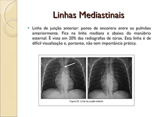 Linhas Mediastinais Linha de junção anterior: ponto de encontro entre os pulmões anteriormente. Fica na linha mediana e abaixo do manúbrio esternal. É vista em 20% das radiografias de tórax.  Esta linha é de difícil visualização e, portanto, não tem importância prática.  