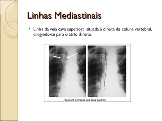 Linhas Mediastinais Linha da veia cava superior:  situada à direita da coluna vertebral, dirigindo-se para o átrio direito.  