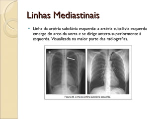 Linhas Mediastinais Linha da artéria subclávia esquerda: a artéria subclávia esquerda emerge do arco da aorta e se dirige antero-superiormente à esquerda. Visualizada na maior parte das radiografias.  