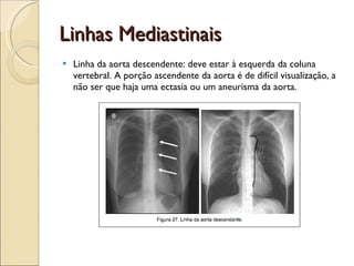 Linhas Mediastinais Linha da aorta descendente: deve estar à esquerda da coluna vertebral. A porção ascendente da aorta é de difícil visualização, a não ser que haja uma ectasia ou um aneurisma da aorta.  