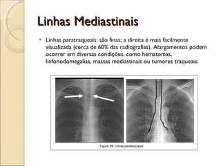Linhas Mediastinais Linhas paratraqueais: são finas; a direita é mais facilmente visualizada (cerca de 60% das radiografias). Alargamentos podem ocorrer em diversas condições, como hematomas, linfonodomegalias, massas mediastinais ou tumores traqueais.  