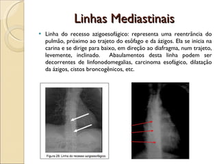 Linhas Mediastinais Linha do recesso azigoesofágico:  representa uma reentrância do pulmão, próximo ao trajeto do esôfago e da ázigos. Ela se inicia na carina e se dirige para baixo, em direção ao diafragma, num trajeto, levemente, inclinado.  Abaulamentos desta linha podem ser decorrentes de linfonodomegalias, carcinoma esofágico, dilatação da ázigos, cistos broncogênicos, etc.  