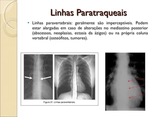 Linhas Paratraqueais Linhas paravertebrais: geralmente são imperceptíveis. Podem estar alargadas em caso de alterações no mediastino posterior (abscessos, neoplasias, ectasia da ázigos) ou na própria coluna vertebral (osteófitos, tumores).  