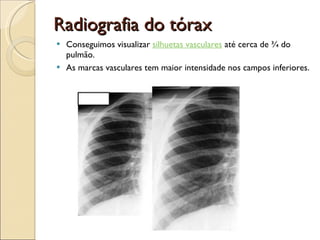 Radiografia do tórax Conseguimos visualizar  silhuetas vasculares  até cerca de ¾ do pulmão.  As marcas vasculares tem maior intensidade nos campos inferiores.  