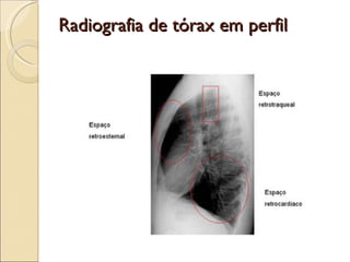 Radiografia de tórax em perfil 