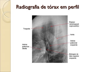 Radiografia de tórax em perfil 