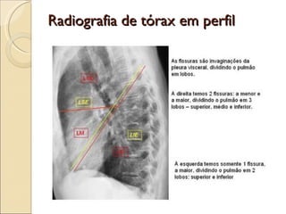 Radiografia de tórax em perfil 