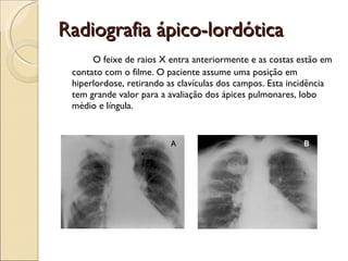 Radiografia ápico-lordótica O feixe de raios X entra anteriormente e as costas estão em contato com o filme. O paciente assume uma posição em hiperlordose, retirando as clavículas dos campos. Esta incidência tem grande valor para a avaliação dos ápices pulmonares, lobo médio e língula. 