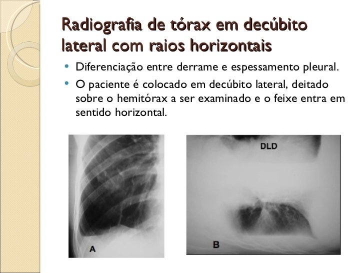 Radiografia normal do tórax