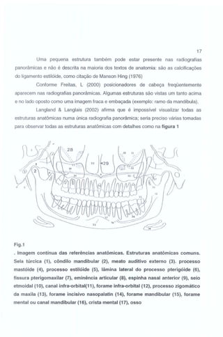 17
Uma pequena estrutura também pode estar presente nas radiografias
panorâmicas e não é descrita na maioria dos textos de anatomia: são as calcificações
do ligamento estilóide, como citação de Manson Hing (1976)
Conforme Freitas, L (2000) posicionadores de cabeça freqüentemente
aparecem nas radiografias panorâmicas. Algumas estruturas são vistas um tanto acima
e no lado oposto como uma imagem fraca e embaçada (exemplo: ramo da mandíbula).
Langland & Langlais (2002) afirma que é impossível visualizar todas as
estruturas anatômicas numa única radiografia panorâmica; seria preciso várias tomadas
para observar todas as estruturas anatômicas com detalhes como na figura 1

Fig.1
. Imagem contínua das referências anatômicas. Estruturas anatômicas comuns.
Sela túrcica (1 ), côndilo mandibular (2), meato auditivo externo (3). processo
mastóide (4), processo estilóide (5), lâmina lateral do processo pterigóide (6),
fissura pterigomaxilar (7), eminência articular (8), espinha nasal anterior (9), seio
etmoidal (1 0), canal infra-orbital(11 ), foram e infra-orbital (12), processo zigomático
da maxila (13), forame incisivo nasopalatin (14), forame mandibular (15), forame
mental ou canal mandibular (16), crista mental (17), osso

 