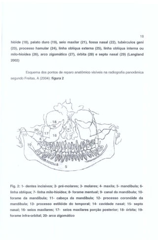 18

hióide (18), palato duro (19), seio maxilar (21), fossa nasal (22), tubérculos geni

(23), processo hamular (24), linha oblíqua externa (25), linha oblíqua interna ou
milo-hioídea (26), arco zigomático (27), órbita (28) e septo nasal (29) (Langland

2002)
Esquema dos pontos de reparo anatômico visíveis na radiografia panorâmica
segundo Freitas, A (2004): figura 2

Fig. 2: 1- dentes incisivos; 2- pré-molares; 3- molares; 4- maxila; 5- mandíbula; 6linha oblíqua; 7- linha milo-hioídea; 8- forame mentual ; 9- canal da mandíbula; 10forame da mandíbula; 11- cabeça da mandíbula; 12- processo coronóide da
mandíbula; 13- processo estilóide do temporal; 14- cavidade nasal; 15- septo
nasal; 16- seios maxilares; 17- seios maxilares porção posterior; 18- órbita; 19forame infra-orbital; 20- arco zigomático

 