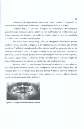 21

A interpretação da radiografia panorâmica requer uma boa compreensão da
formação das imagens reais e fantasmas conforme lembra Kartz et ai (1989)
Segundo Kartz, o uso dos princípios de interpretação da radiografia
panorâmica são necessários para a observação de calcificações em tecidos moles que
podem aparecer, por exemplo, na região de terceiro molar e ramo da mandíbula
confundindo-se com lesões nessas regiões.
De acordo com Manson Hing (1985) as radiografias panorâmicas podem
produzir imagens insólitas. A figura a e a' mostram imagens invertidas dos brincos
metálicos. O artifício é causado pelo fato de o feixe de raios X ter que passar através da
área do ramo oposto quando a região posterior de um dos lados dos maxilares é
percorrida. Assim a imagem do lado direito é causada pelo brinco na orelha esquerda.
Na imagem, a parte antero- posterior do brinco é invertida pois o centro de rotação do
feixe está localizado entre o brinco e o maxilar que está sendo examinado.
Whaites (2003) diz que imagens fantasmas ou artefatos podem sobrepor
estruturas que estão dentro da área focal. Exemplos de artefatos mais comuns: falha na
remoção de brincos metálicos, colar, próteses parciais metálicas, aparelho ortodôntico
móvel, avental de chumbo colocado muito superior no pescoço, placas ósseas
metálicas utilizadas para fixação de fratura.

figura a: imagens de brincos metálicos

 
