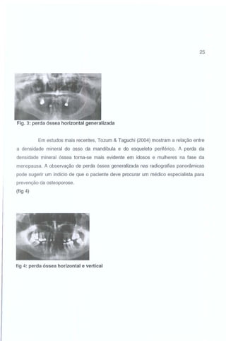 25

Fig. 3: perda óssea horizontal generalizada

Em estudos mais recentes, Tozum & Taguchi (2004) mostram a relação entre
a densidade mineral do osso da mandíbula e do esqueleto periférico. A perda da
densidade mineral óssea torna-se mais evidente em idosos e mulheres na fase da
menopausa. A observação de perda óssea generalizada nas radiografias panorâmicas
pode sugerir um indício de que o paciente deve procurar um médico especialista para
prevenção da osteoporose.
(fig 4)

fig 4: perda óssea horizontal e vertical

 