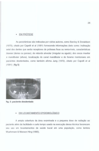26

•

EM PRÓTESE

As panorâmicas são indicadas por vários autores, como Barclay & Donaldson
(1970), citado por Capelli et ai (1991) fornecendo informações úteis como: inclinação
axial dos dentes que serão receptores de próteses fixas ou removíveis, características
ósseas (denso ou poroso), do rebordo alveolar (irregular ou agudo), dos ossos maxilar
e mandibular (altura), localização do canal mandibular e do forame mentoniano em
pacientes desdentados, como também afirma Jung (1972), citado por Capelli et ai
(1991) (fig 5)

fig. 5: paciente desdentado

•

EM LEVANTAMENTO EPIDEMIOLÓGICO

A ampla cobertura da área examinada e a pequena dose de radiação ao
paciente além da facilidade e curto tempo usado na execução dessa técnica favorecem
seu uso em levantamentos de saúde bucal em uma população, como lembra
Wuehrmam & Manson Hing (1985).

 