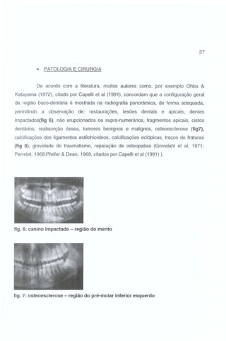 27

•

PATOLOGIA E CIRURGIA

De acordo com a literatura, muitos autores como, por exemplo Ohba &
Katayama (1972), citado por Capelli et ai (1991), concordam que a configuração geral
da região buco-dentária é mostrada na radiografia panorâmica, de forma adequada,
permitindo a observação de:

restaurações,

lesões dentais e apicais, dentes

impactados(fig 6), não erupcionados ou supra-numerários, fragmentos apicais, cistos
dentários, reabsorção óssea, tumores benignos e malignos, osteoesclerose (fig7),
calcificações dos ligamentos estilohioídeos, calcificações ectópicas, traços de fraturas
(fig 8), gravidade do traumatismo, reparação de osteopatias (Grondahl et ai, 1971;

Perrelet, 1968;Pfeifer & Dean, 1969, citados por Capelli et ai (1991) ).

fig. 6: canino impactado- região do mento

fig. 7: osteoesclerose - região do pré-molar inferior esquerdo

 