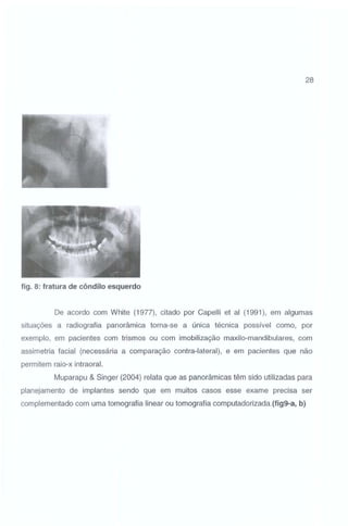 28

. '.· ~ ,

. , ..".·_·
.
),f"'
·.

..

_ - -__

~

'

',
'

·.

.

1

fig. 8: fratura de côndilo esquerdo

De acordo com White (1977), citado por Capelli et ai (1991 ), em algumas
situações a radiografia panorâmica torna-se a única técnica possível como, por
exemplo, em pacientes com trismos ou com imobilização maxilo-mandibulares, com
assimetria facial (necessária a comparação contra-lateral), e em pacientes que não
permitem raio-x intraoral.
Muparapu & Singer (2004) relata que as panorâmicas têm sido utilizadas para
planejamento de implantes sendo que em muitos casos esse exame precisa ser
complementado com uma tomografia linear ou tomografia computadorizada.(fig9-a, b)

 