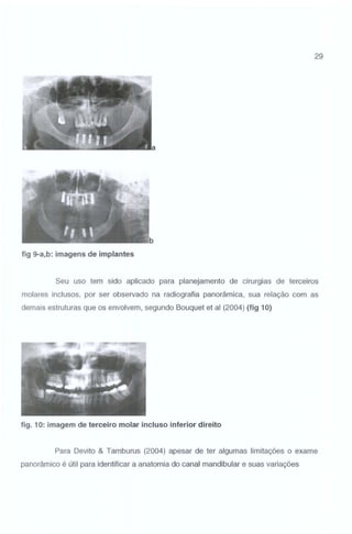 29

fig 9-a,b: imagens de implantes

Seu uso tem sido aplicado para planejamento de cirurgias de terceiros
molares inclusos, por ser observado na radiografia panorâmica, sua relação com as
demais estruturas que os envolvem, segundo Bouquet et ai (2004) (fig 10)

fig. 10: imagem de terceiro molar incluso inferior direito

Para Devito & Tamburus (2004) apesar de ter algumas limitações o exame
panorâmico é útil para identificar a anatomia do canal mandibular e suas variações

 