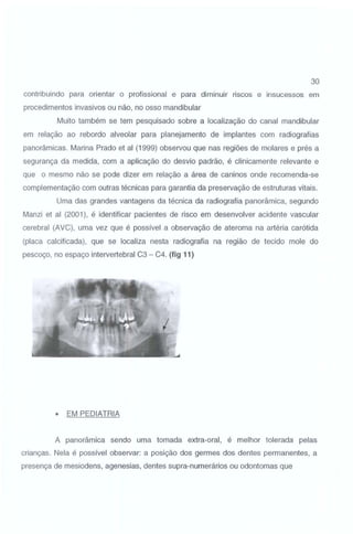 30
contribuindo para orientar o profissional e para diminuir riscos e insucessos em
procedimentos invasivos ou não, no osso mandibular
Muito também se tem pesquisado sobre a localização do canal mandibular
em relação ao rebordo alveolar para planejamento de implantes com radiografias
panorâmicas. Marina Prado et ai (1999) observou que nas regiões de molares e prés a
segurança da medida, com a aplicação do desvio padrão, é clinicamente relevante e
que o mesmo não se pode dizer em relação a área de caninos onde recomenda-se
complementação com outras técnicas para garantia da preservação de estruturas vitais.
Uma das grandes vantagens da técnica da radiografia panorâmica, segundo
Manzi et ai (2001 ), é identificar pacientes de risco em desenvolver acidente vascular
cerebral (AVC), uma vez que é possível a observação de ateroma na artéria carótida
(placa calcificada), que se localiza nesta radiografia na região de tecido mole do
pescoço, no espaço intervertebral C3- C4. (fig 11)

•

EM PEDIATRIA

A panorâmica sendo uma tomada extra-oral, é melhor tolerada pelas
crianças. Nela é possível observar: a posição dos germes dos dentes permanentes, a
presença de mesiodens, agenesias, dentes supra-numerários ou odontomas que

 
