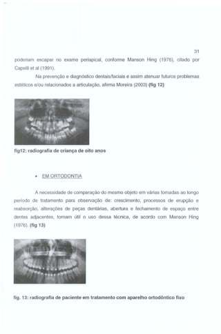 31

poderiam escapar no exame periapical, conforme Manson Hing (1976), citado por
Capelli et ai (1 991 ).
Na prevenção e diagnóstico dentais/faciais e assim atenuar futuros problemas
estéticos e/ou relacionados a articulação, afirma Moreira (2003) (fig 12)

fig12: radiografia de criança de oito anos

•

EM ORTODONTIA

A necessidade de com paração do mesmo objeto em várias tomadas ao longo
período de tratamento para observação de: crescimento, processos de erupção e
reabsorção, alterações de peças dentárias, abertura e fechamento de espaço entre
dentes adjacentes, tornam útil o uso dessa técnica, de acordo com Manson Hing
(1976). (fig 13)

fig. 13: radiografia de paciente em tratamento com aparelho ortodôntico fixo

 