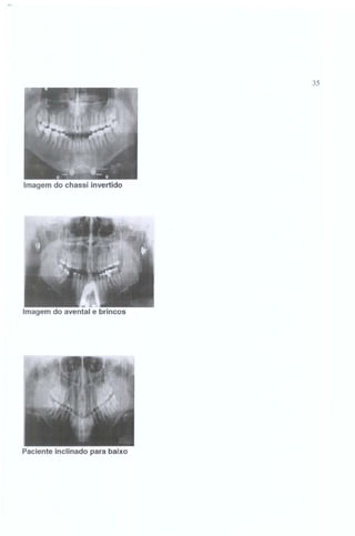35

Imagem do chassi invertido

-

Imagem do avental e brincos

Paciente inclinado para baixo

 