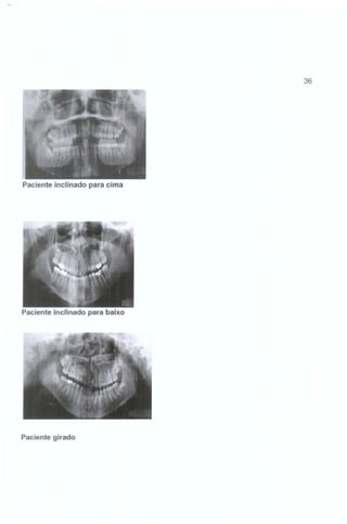 36

Paciente inclinado para cima

Paciente inclinado para baixo

Paciente girado

 