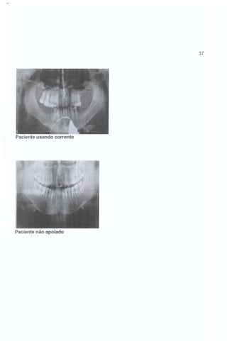 37

Paciente usando corrente

Paciente não apoiado

 