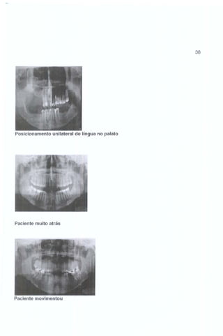 38

Posicionamento unilateral do língua no palato

Paciente muito atrás

Paciente movimentou

 