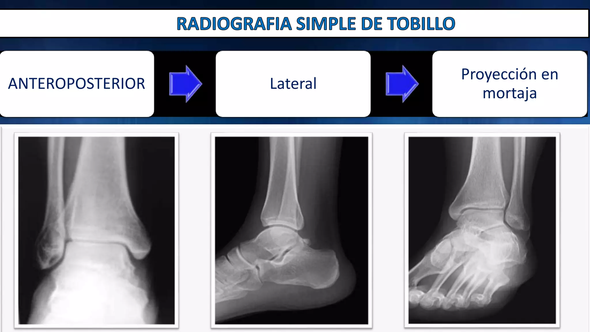 Radiografia de pie - tobillo y tibia - perone | PPTX