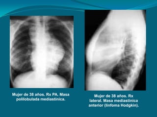 Mujer de 38 años. Rx PA. Masa      Mujer de 38 años. Rx
 polilobulada mediastínica.     lateral. Masa mediastínica
                                anterior (linfoma Hodgkin).
 