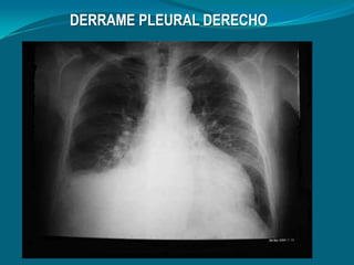 DERRAME PLEURAL DERECHO
 