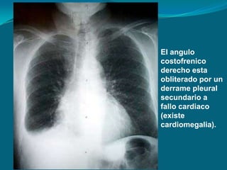 El angulo
costofrenico
derecho esta
obliterado por un
derrame pleural
secundario a
fallo cardiaco
(existe
cardiomegalia).
 