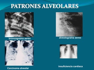 broncograma aereo   alveolograma aereo




                     insuficiencia cardiaca
Carcinoma alveolar
 