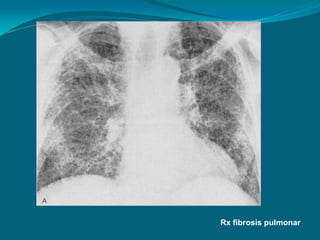 Rx fibrosis pulmonar
 
