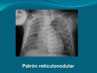 Patrón retículonodular
 