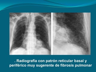 . Radiografía con patrón reticular basal y
periférico muy sugerente de fibrosis pulmonar
 