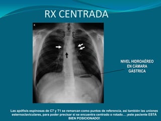 RX CENTRADA



                                                                       NIVEL HIDROAÉREO
                                                                          EN CÁMARA
                                                                           GÁSTRICA




Las apófisis espinosas de C7 y T1 se remarcan como puntos de referencia, así también las uniones
 esternoclaviculares, para poder precisar si se encuentra centrado o rotado… ¡este paciente ESTÁ
                                       BIEN POSICIONADO!
 