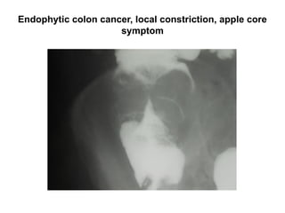 Radiogram Interpretations for Lung, Bone, and Gastrointestinal Cancers ...
