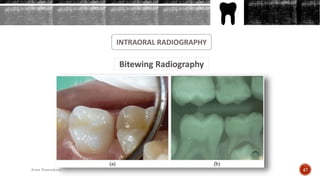 INTRAORAL RADIOGRAPHY
Bitewing Radiography
47Arwa Namnakani
 